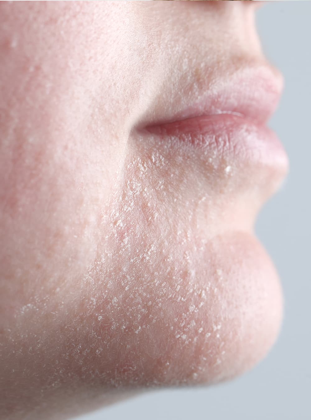 najlepszy krem do twarzy dla skóry trądzikowej